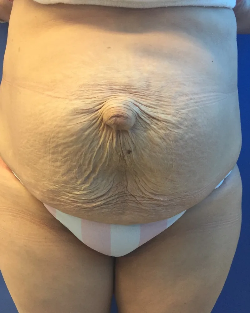 Hernia de la pared abdominal antes de la cirugía: el abdomen abombado, con el defecto de la pared que sobresale