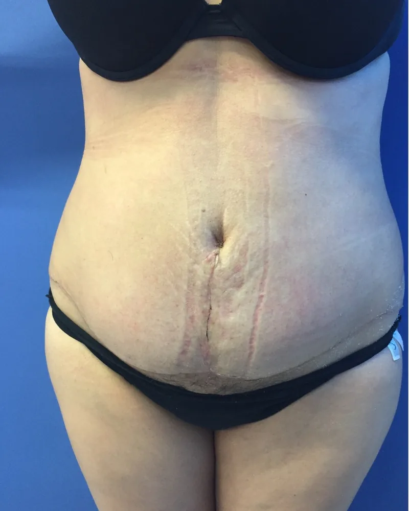 Pared abdominal reparada con malla después de la cirugía, en la misma paciente