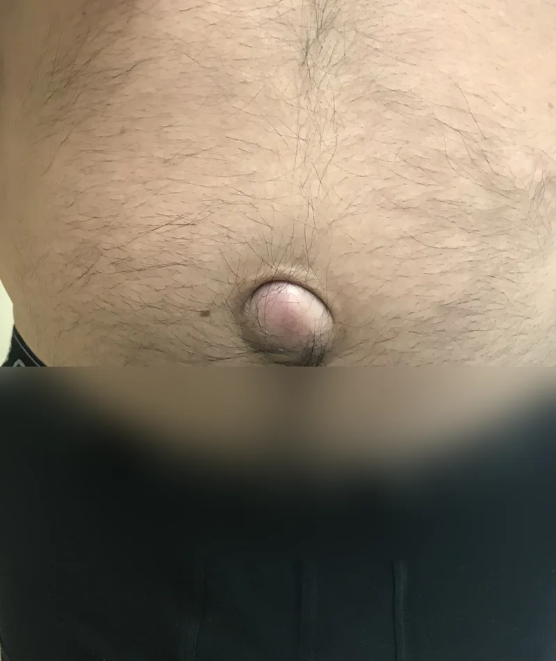 Hernia umbilical prominente: una bola que sobresale en el ombligo de un paciente antes de la cirugía