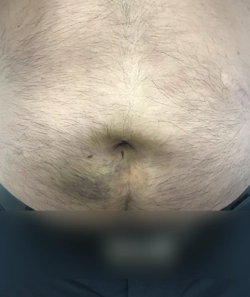 Ombligo reparado después de la plastia umbilical con malla, en el mismo paciente